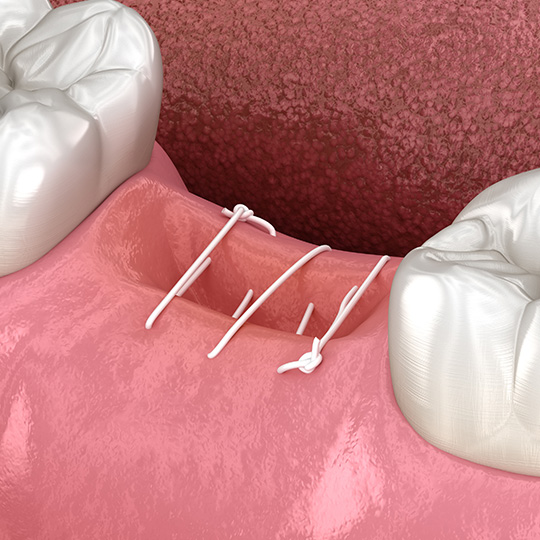 Для скорейшего заживления и меньшего кровотечения накладываются дополнительные швы Дополнительные швы