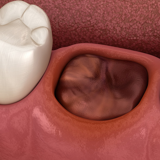 Обратитесь к врачу, если гематома гноится и болит Гематома после удаления зуба