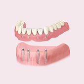 Как выглядит съёмный протез на кнопочной фиксации Фото съёмного протеза на кнопочной фиксации