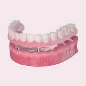 Как выглядит съёмный протез на балочной фиксации Фото съёмного протеза на балочной фиксации
