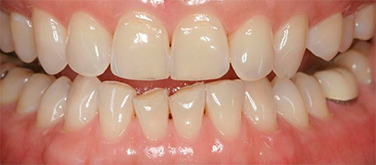 фото всех зубов до установки керамических виниров