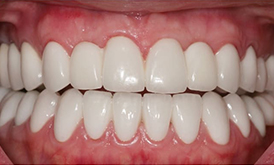 фото после установки 16 виниров