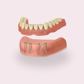 Как выглядит протез на имплантах Фото протеза на имплантах