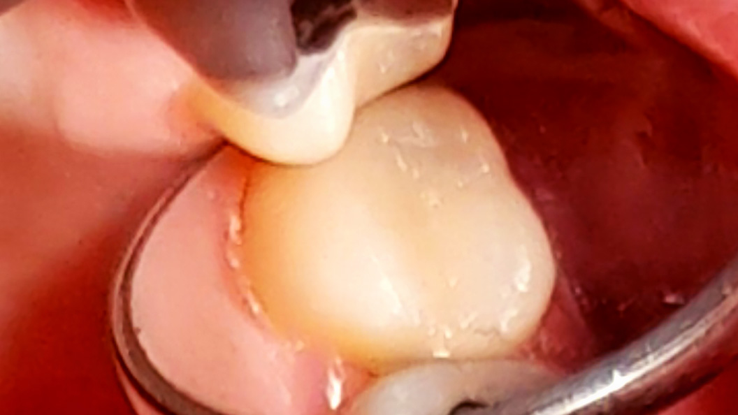 Фото вылеченного 27 зуба