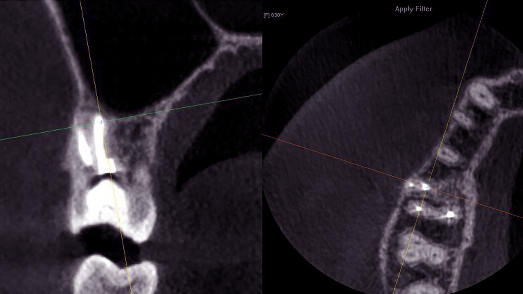 Фото после лечения хронического периодонтита