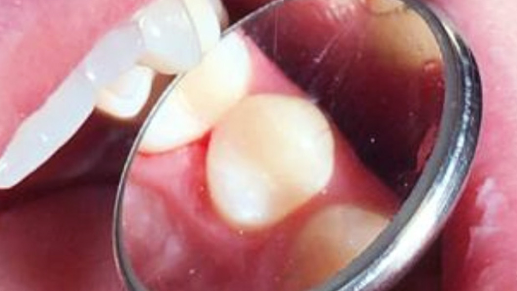 Фото премоляра после лечения