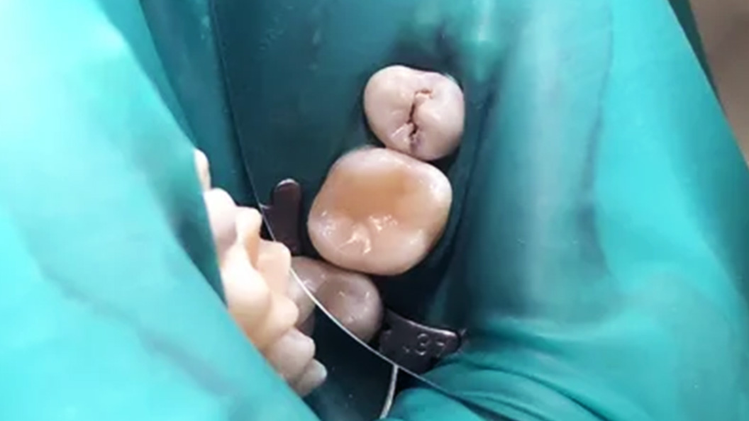 Фото зубов после пломбировки каналов