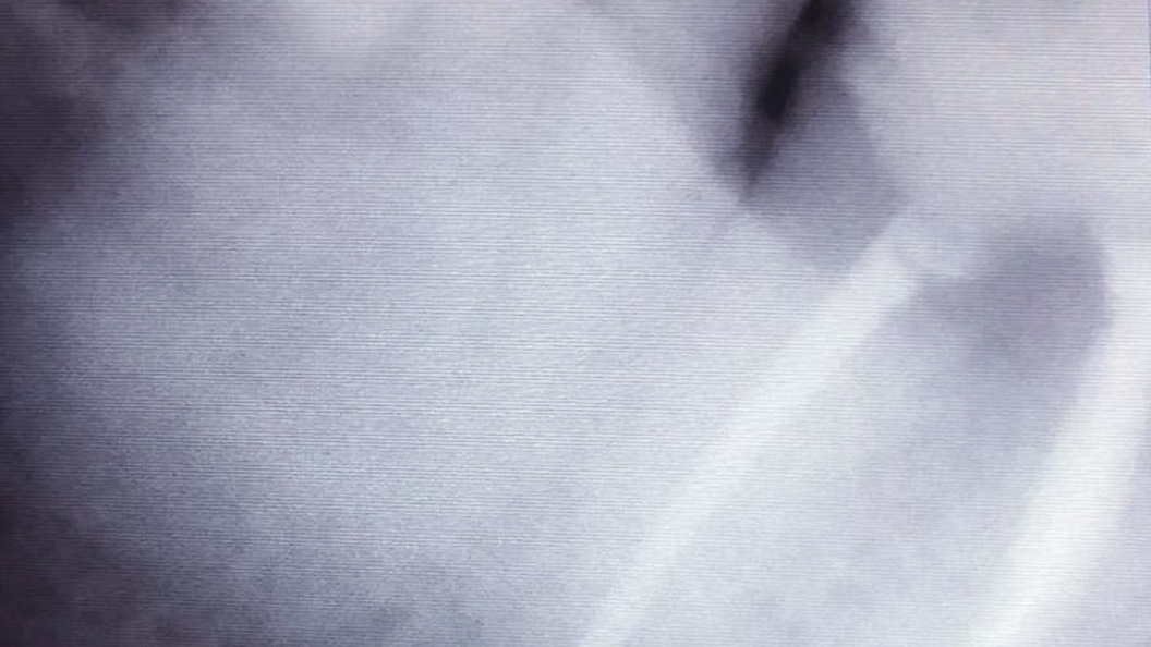 Фото после лечения пульпита 4.7 зуба