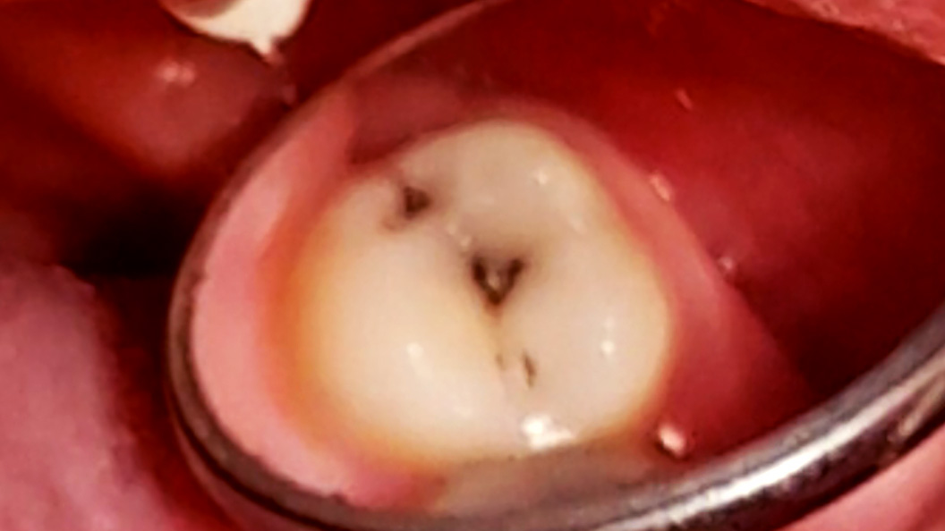 Фото кариеса 27 зуба
