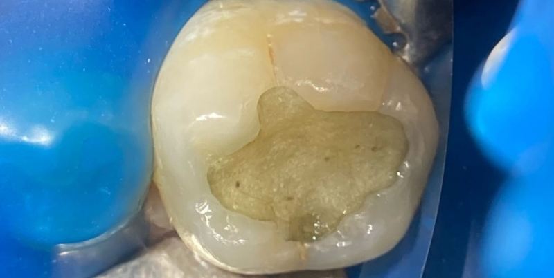 Фото зуба до реставрации