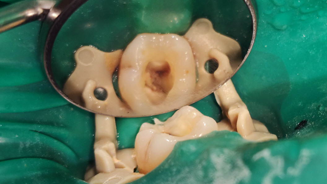 Фото пульпита зуба