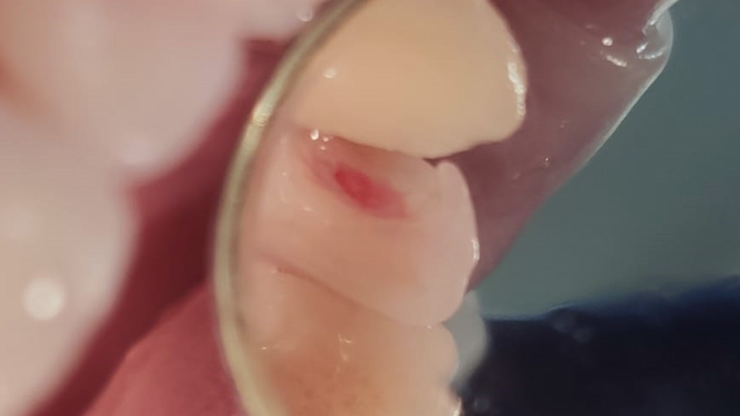 Фото зуба с пульпитом