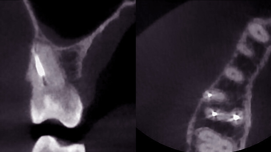 Фото до лечения хронического периодонтита