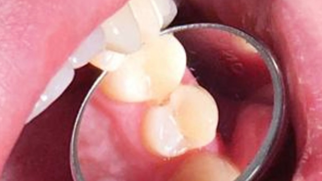 Глубокий кариес премоляра