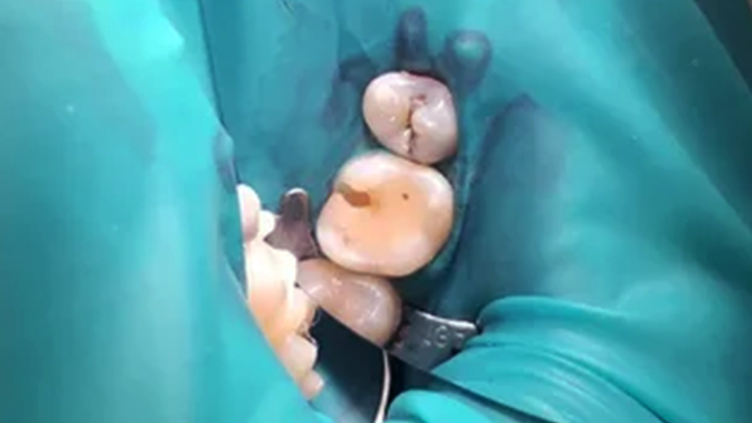 Фото зубов до пломбировки каналов