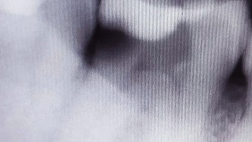 Фото пульпита 4.7 зуба